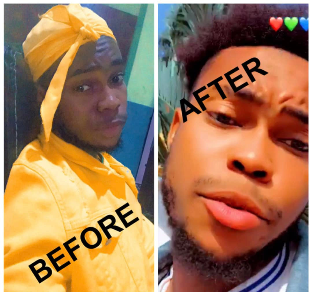 Lips Lightening Cream For Men and Women (Results in 5 Days or Less)