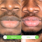 Lips Lightening Cream For Men and Women (Results in 5 Days or Less)